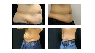 Coolsculpting Fat Freezing Treatment  Does it work [upl. by Brendin]