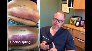 Sculpsure vs Coolsculpting  Which One is Better [upl. by Zenia486]