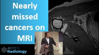 Imaging brain tumors  5  Non glial tumors [upl. by Anneiv]