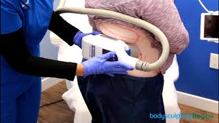 CoolSculpting Upper Flanks  Body Sculpting Regina  DEMO [upl. by Brick512]